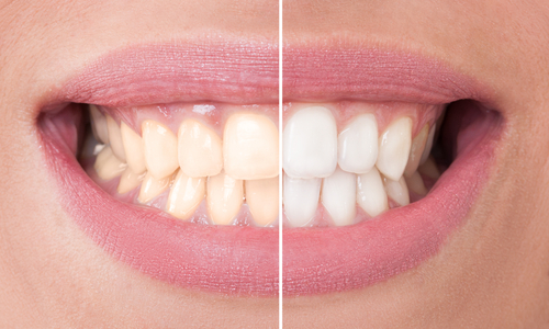 SEVEN TIPS TO ENCOURAGE MORE PATIENTS TO SAY YES TO TEETH WHITENING TREATMENT